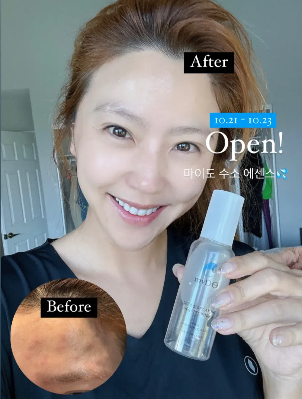 피부 문제점을 근본적으로 해결하는 [수소에센스💧]