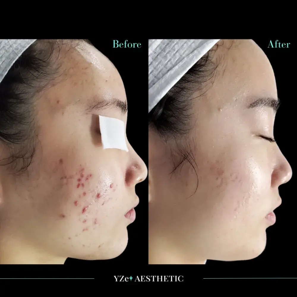 타겟 : 양 볼에 침착된 ‘붉은 색소 ’