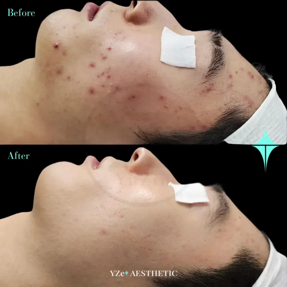 타겟 : ’화농•염증성 여드름‘ ,    ‘붉은 색소’