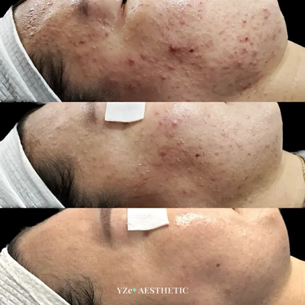 타겟 : 목까지 번진 ‘화농성•좁쌀여드름 및 흉터’