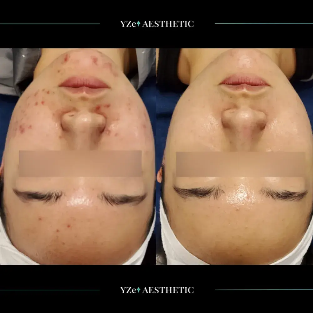 타겟 : 얼굴 전체에 지속적으로 올라오는 ‘여드름’