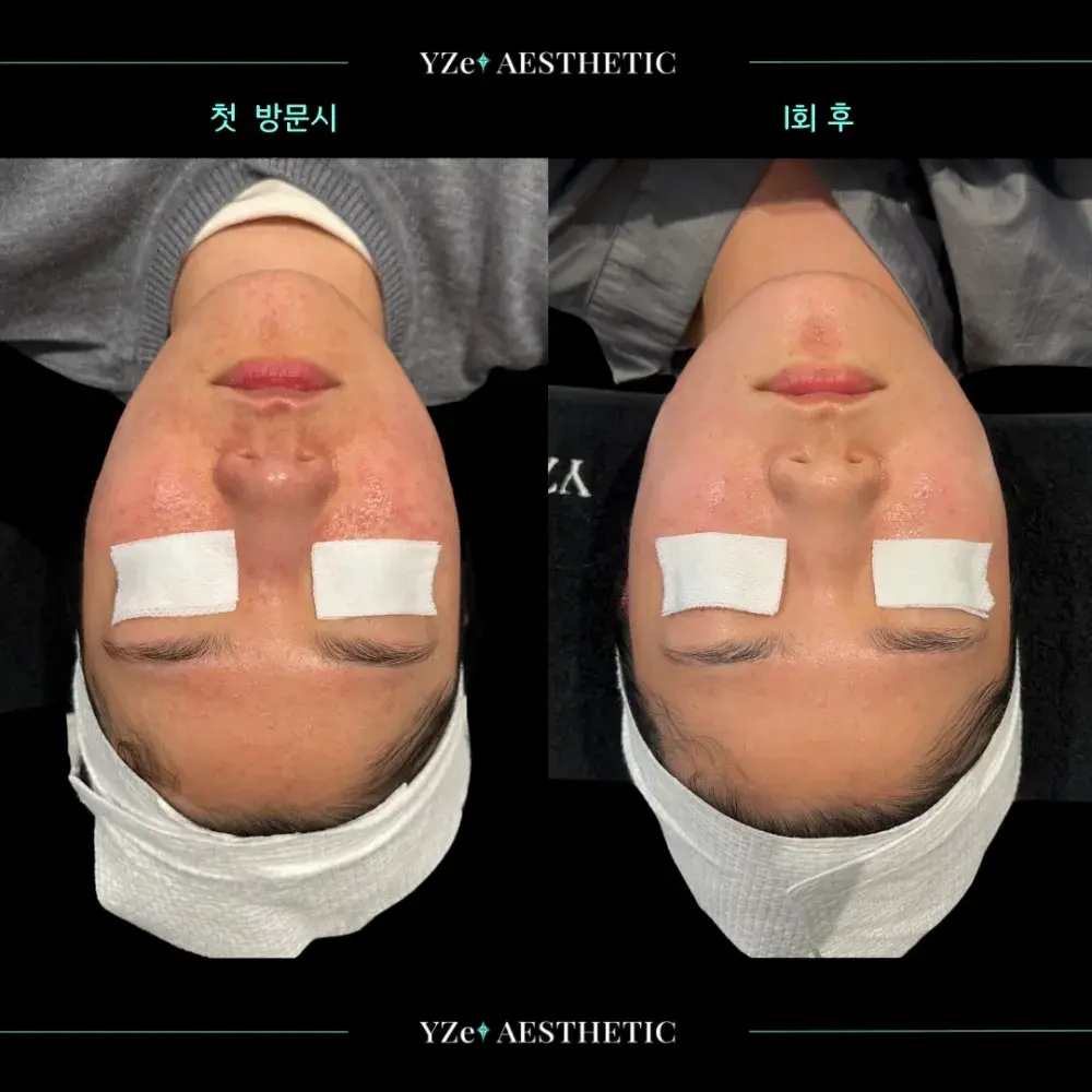 타겟 : 점점 번져가는 ‘모낭염‘ , ’뜨거운 열감‘