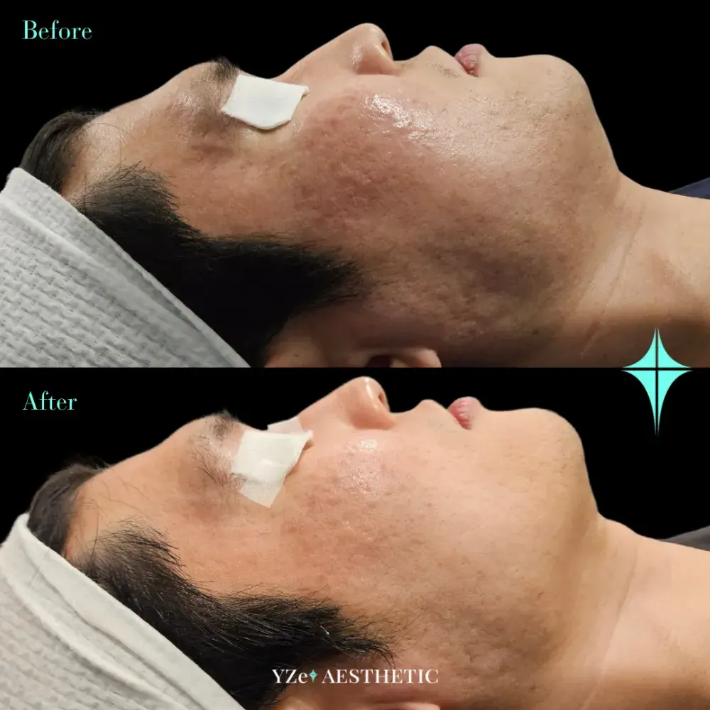 타겟 : 수년간 받아온 강한 시술로 ’무너진 피부장벽’