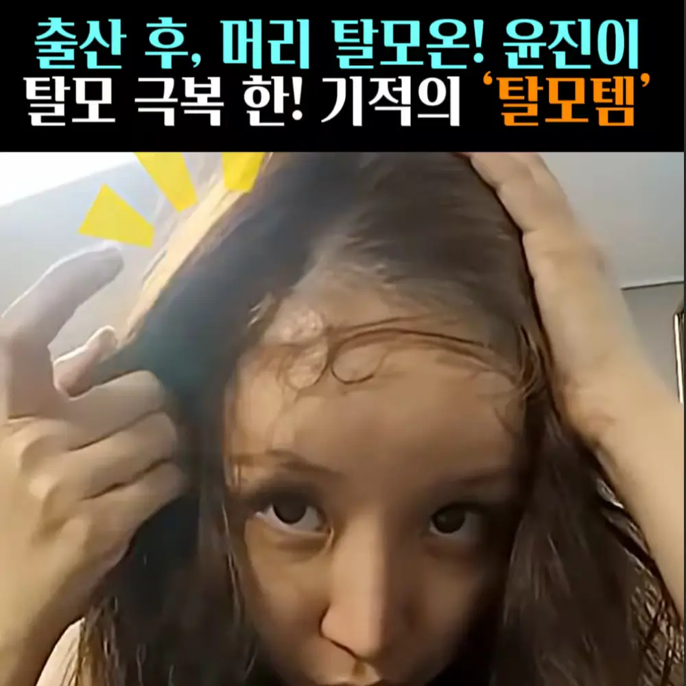 🧚#387. 윤진이, 탈모 구원템