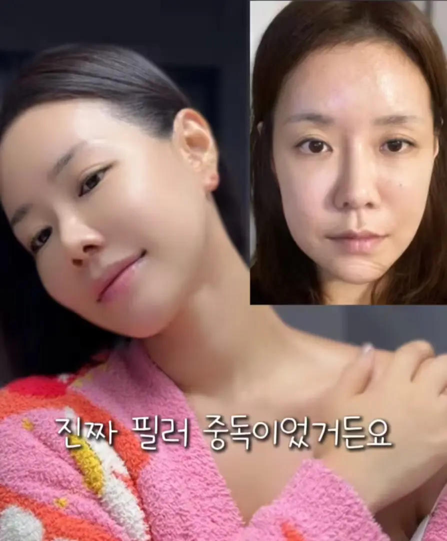 필러 중독 피부원장 강추 “볼륨빵빵크림”