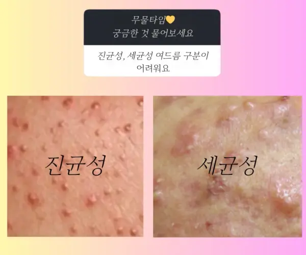 무결점미(美)를 선사할 등드름, 가드름 해결법  by. 주연약사