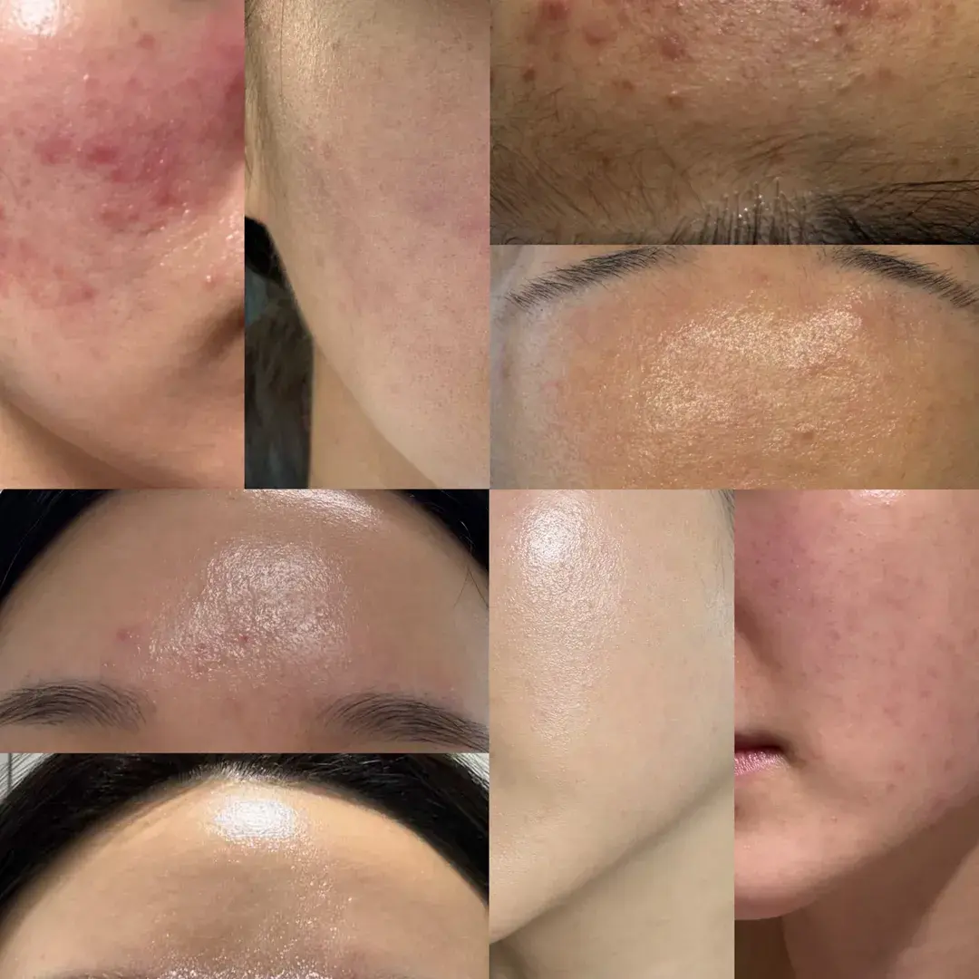 터널즈 홈케어 코칭 비포&애프터 후기✨