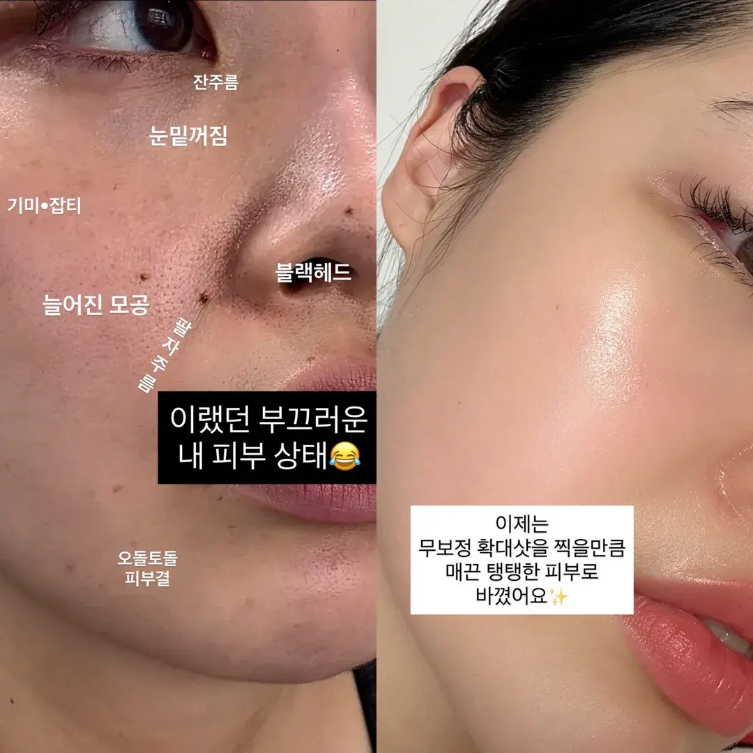 곧 마흔 스뮤즈 대표의 피부성형 [ 슈젝홈 4주 후 ]