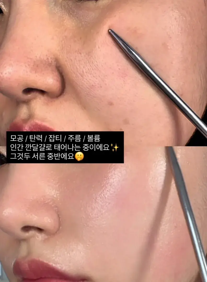 서른중반 피부박사 리겐대표 피부비결 [모공키트 4주후]